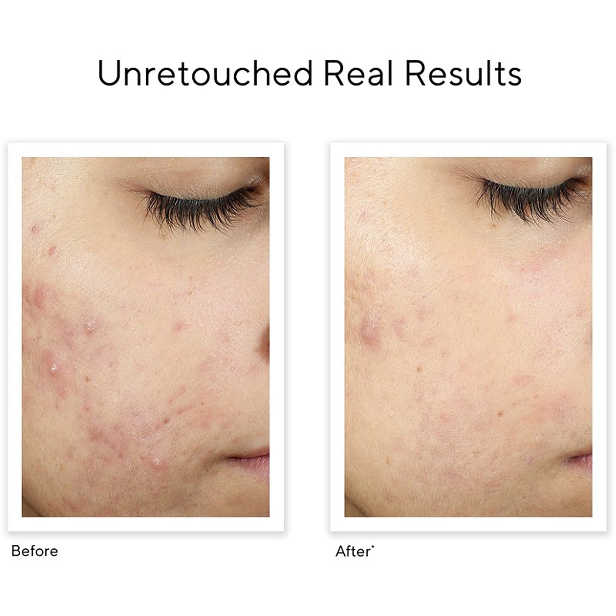 Murad InvisiScar Resurfacing Treatment