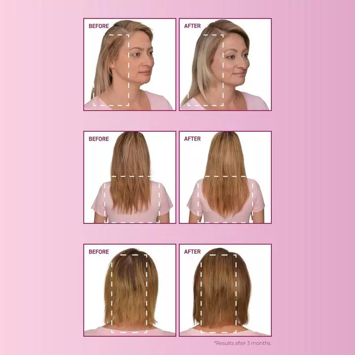 Bosley mendxtend strengthening system result